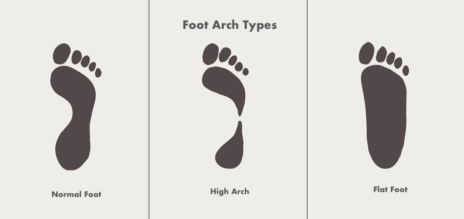 Foot Arch types2